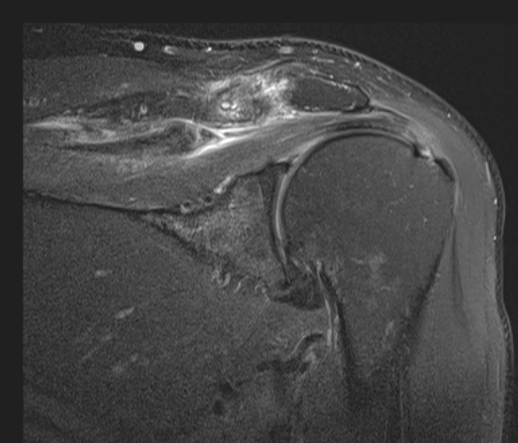 Figure 2 for case Massive interstitial delamination of Supraspinatus with retraction